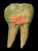 tooth_animation(endodonti)